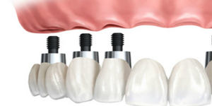 dental implants in Sale