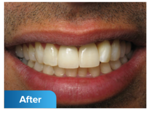 After dental implants photo