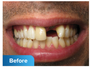 Before dental implants photo - cheshire dental