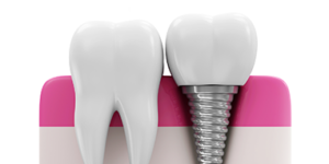 teeth implants in Altrincham