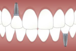 multiple teeth implants in Cheshire