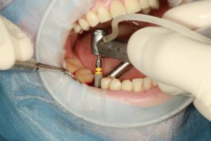 dental implant surgery in Bramhall