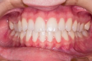 dental implants patient alderley edge