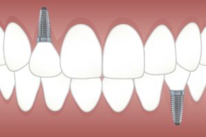 illustration of dental implants