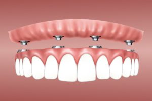 overdenture dental implants in denton - Dental Implants Manchester