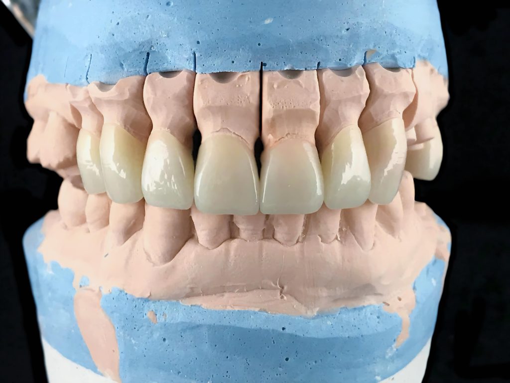 model of teeth for a dental implants procedure