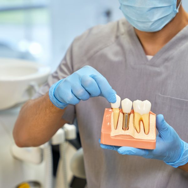 man showing 3d model of dental implants next to healthy teeth