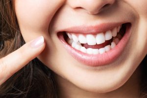 dental veneers