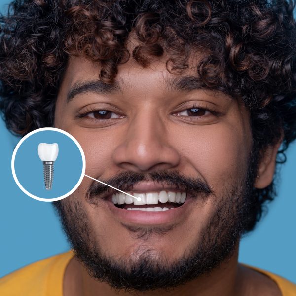 Single dental implants