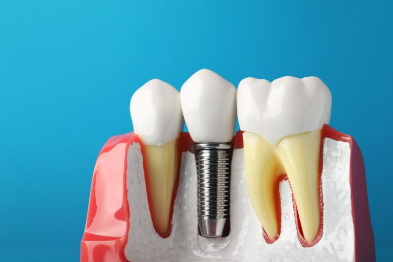 dental implant treatment