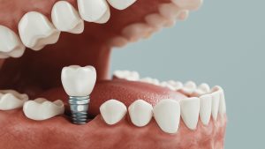 Dental Implants in Edgeley
