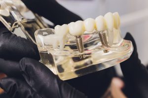 Dental implants in Bosden Farm
