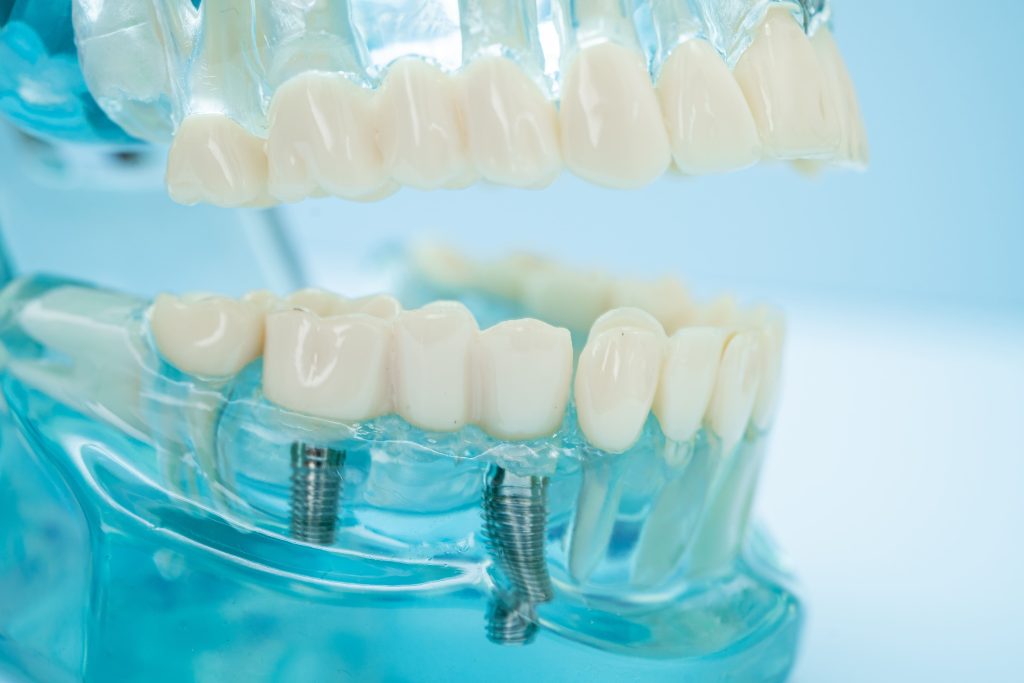 Multiple Dental Implants