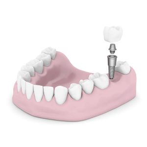 Dental Implants Bredbury