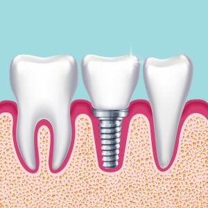 Dental Implants Manchester