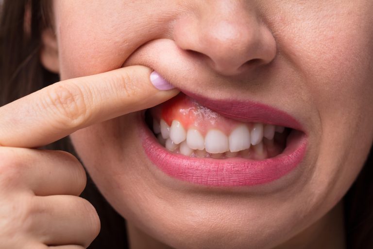 dental implants with gum disease