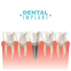 Dental Implant Thameside