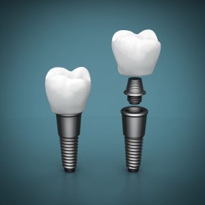 Dental Implants Leek