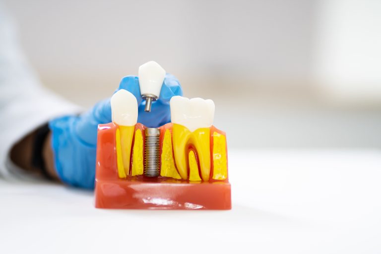 delay replacing a missing tooth - Solution