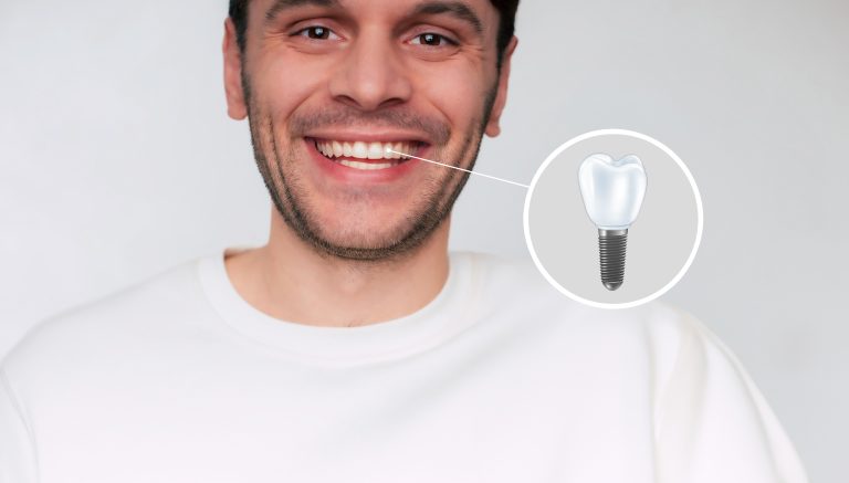 Dental implants becoming more common in patients under 50